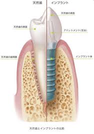 インプラント1